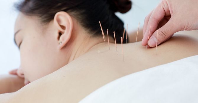 How Does Acupuncture for Stress Relief Support Calm and Balance?
