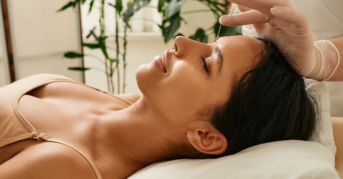 How Acupuncture Helps With Headaches and Why It Works image